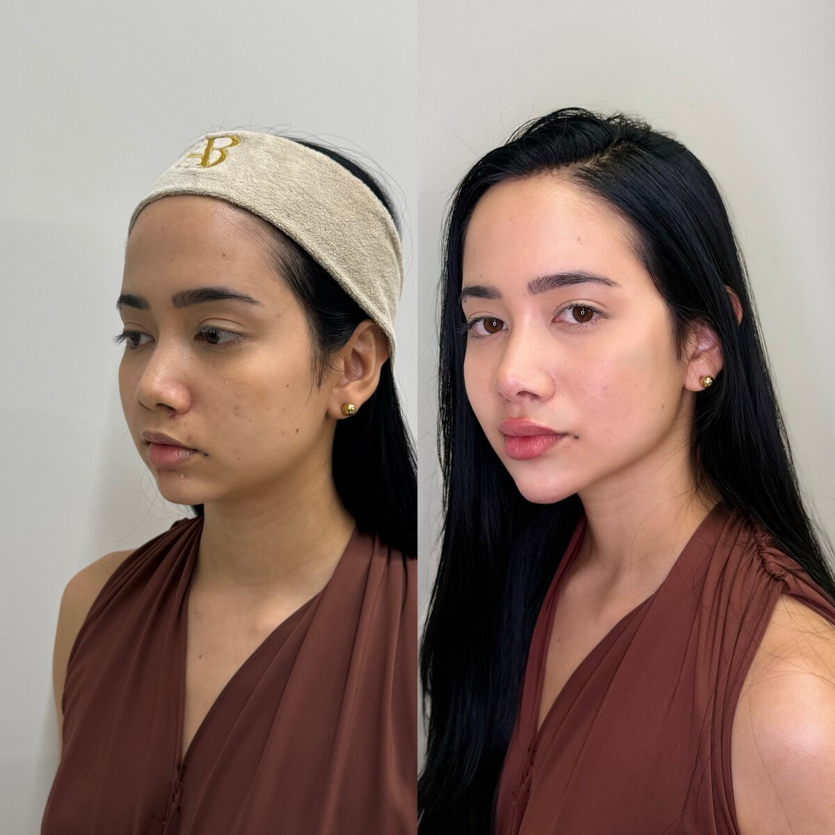 Resultado facial antes e depois do Instituto Welisson Carvalho